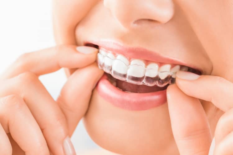 יישור שיניים למבוגרים⁩